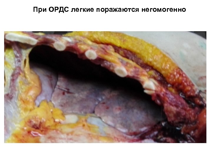 При ОРДС легкие поражаются негомогенно 