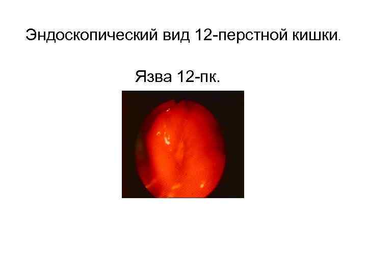 Эндоскопический вид 12 -перстной кишки. Язва 12 -пк. 