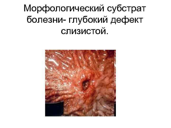 Морфологический субстрат болезни- глубокий дефект слизистой. 