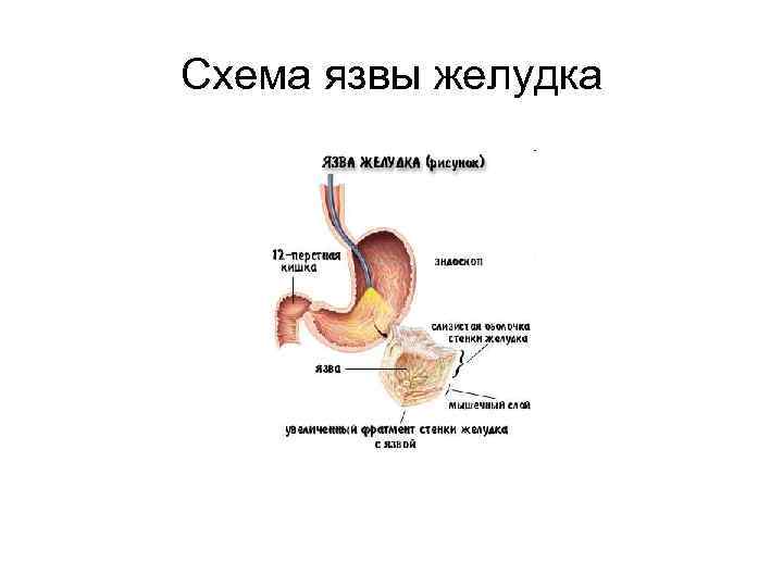 Язвенная болезнь желудка рисунок