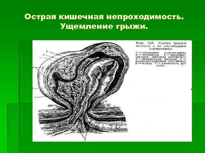 Острая кишечная непроходимость. Ущемление грыжи. 