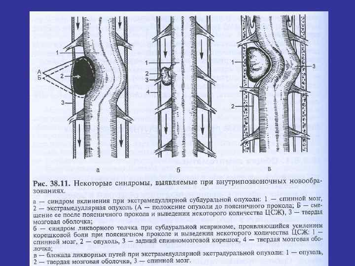 Опухоли головного и спинного мозга презентация