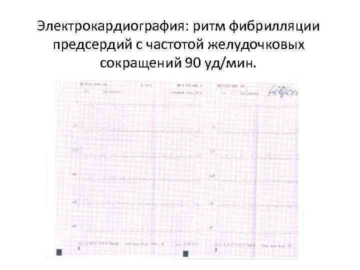 Электрокардиография: ритм фибрилляции предсердий с частотой желудочковых сокращений 90 уд/мин. 