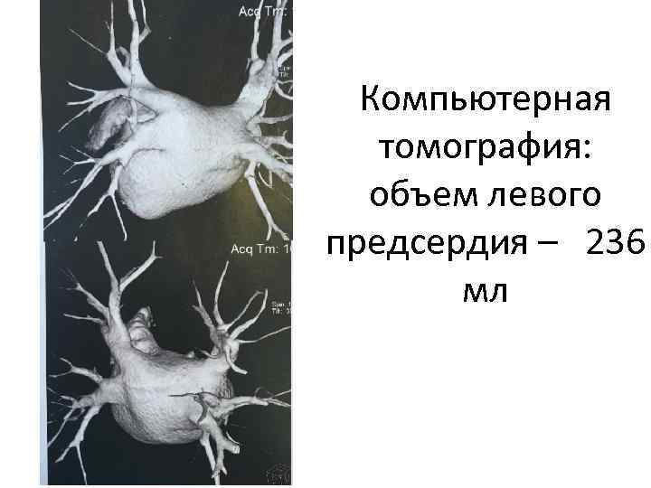 Компьютерная томография: объем левого предсердия – 236 мл 