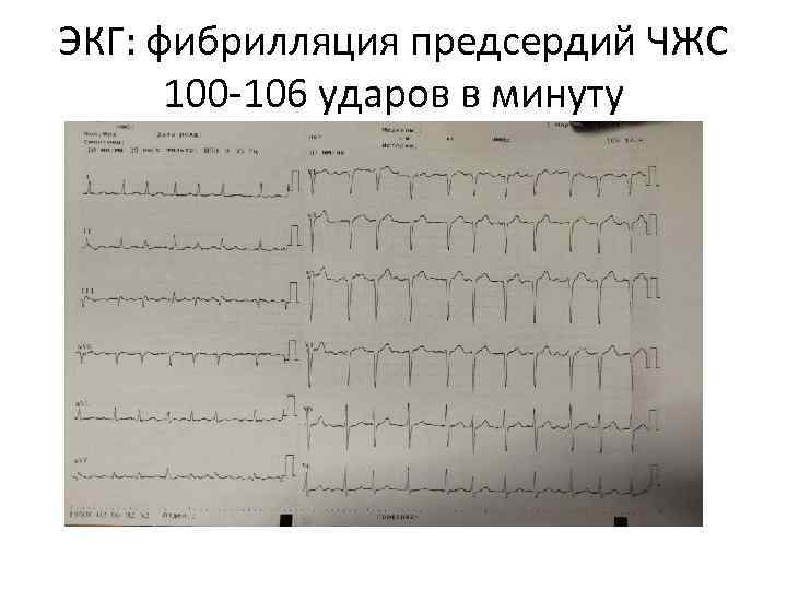 ЭКГ: фибрилляция предсердий ЧЖС 100 -106 ударов в минуту 