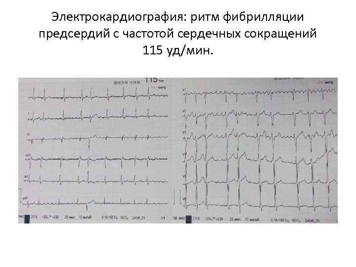 Электрокардиография: ритм фибрилляции предсердий с частотой сердечных сокращений 115 уд/мин. 