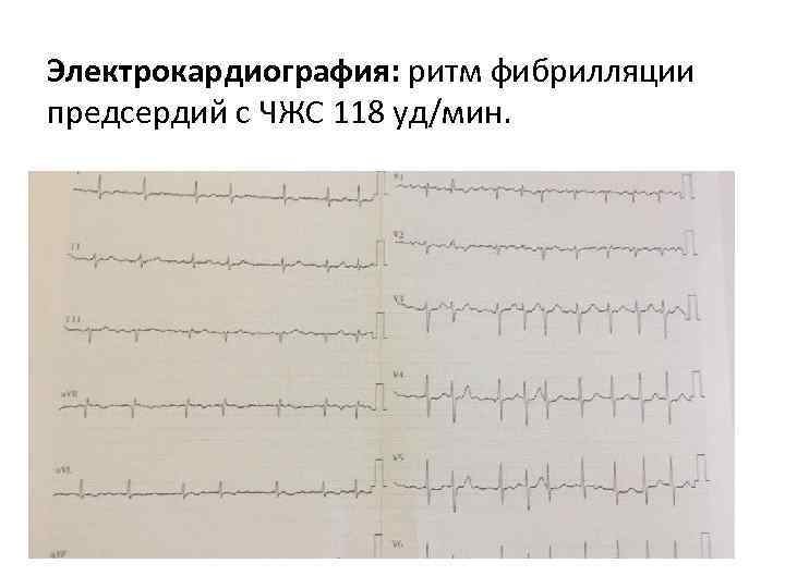 Электрокардиография: ритм фибрилляции предсердий с ЧЖС 118 уд/мин. 