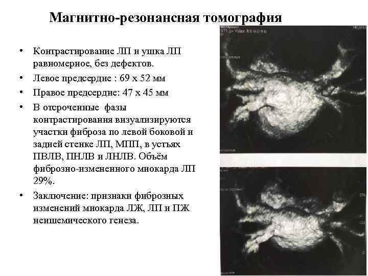 Магнитно-резонансная томография • Контрастирование ЛП и ушка ЛП равномерное, без дефектов. • Левое предсердие