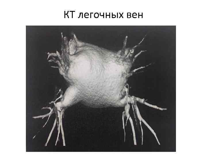 КТ легочных вен 