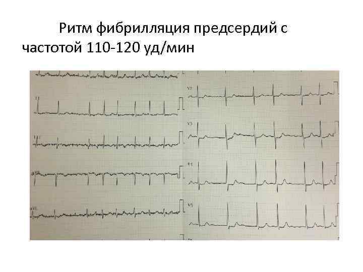 Ритм фибрилляция предсердий с частотой 110 -120 уд/мин 