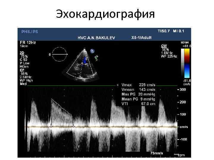 Эхокардиография 