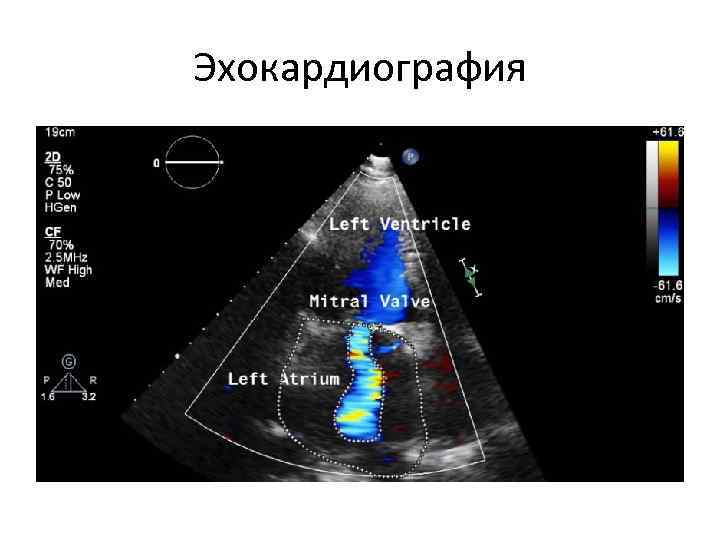 Эхокардиография 