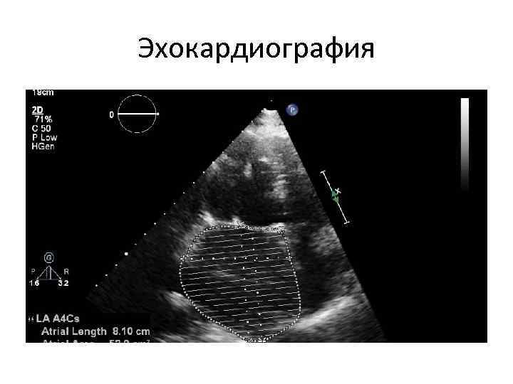 Эхокардиография 