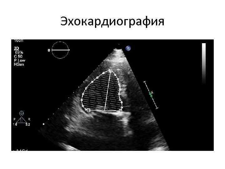Эхокардиография 