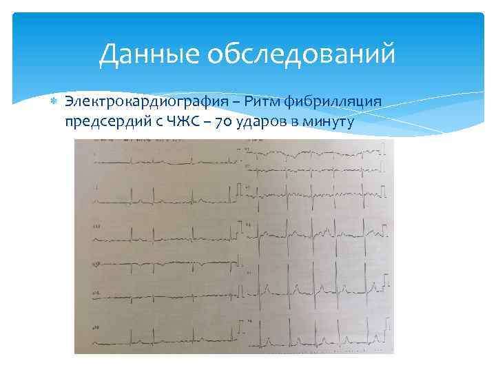 Данные обследований Электрокардиография – Ритм фибрилляция предсердий с ЧЖС – 70 ударов в минуту