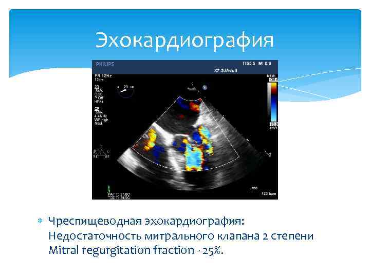 Эхокардиография Чреспищеводная эхокардиография: Недостаточность митрального клапана 2 степени Мitral regurgitation fraction - 25%. 