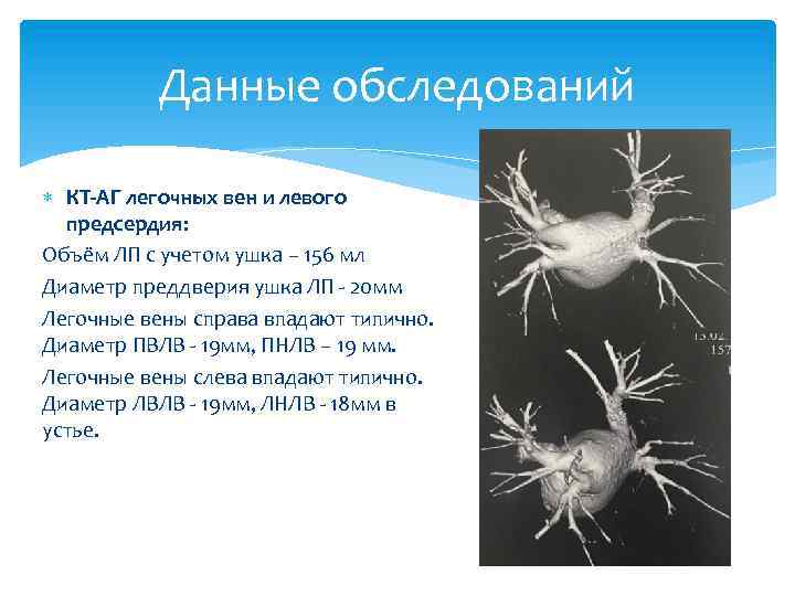 Данные обследований КТ-АГ легочных вен и левого предсердия: Объём ЛП с учетом ушка –