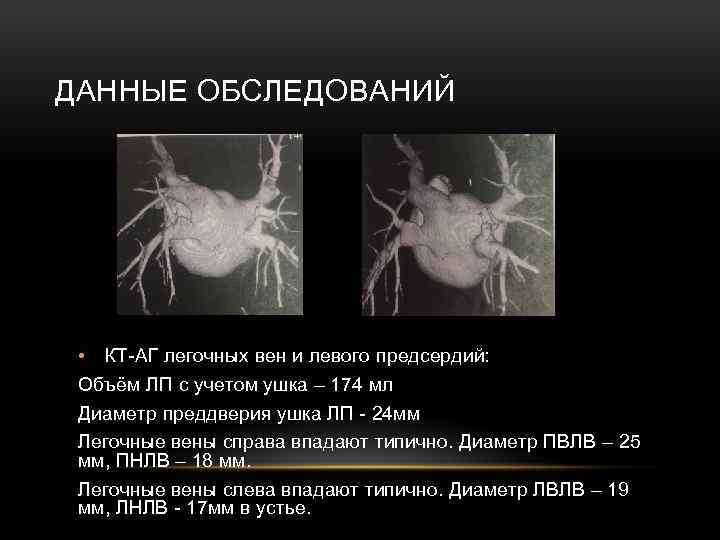 ДАННЫЕ ОБСЛЕДОВАНИЙ • КТ-АГ легочных вен и левого предсердий: Объём ЛП с учетом ушка