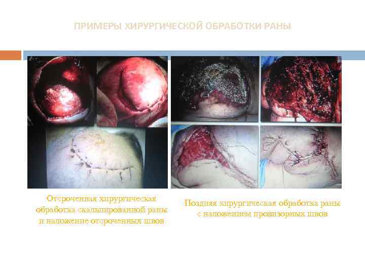 ПРИМЕРЫ ХИРУРГИЧЕСКОЙ ОБРАБОТКИ РАНЫ Отсроченная хирургическая обработка скальпированной раны и наложение отсроченных швов Поздняя