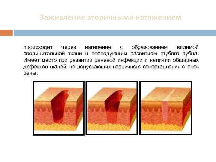 Заживление вторичными натяжением происходит через нагноение с образованием видимой соединительной ткани и последующим развитием