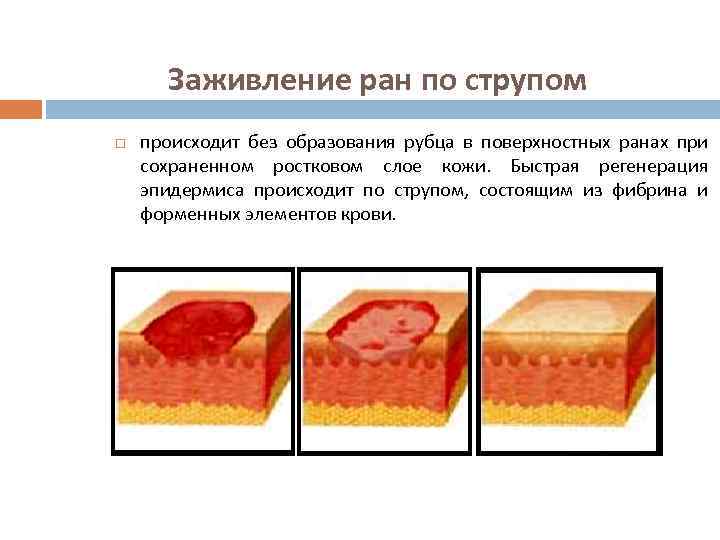 Заживление ран по струпом происходит без образования рубца в поверхностных ранах при сохраненном ростковом