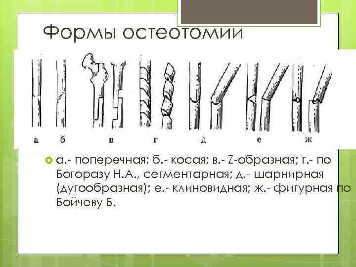 Формы остеотомии а. поперечная; б. косая; в. Z образная; г. по Богоразу Н. А.