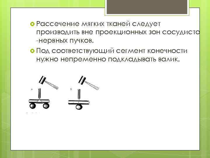  Рассечение мягких тканей следует производить вне проекционных зон сосудисто нервных пучков. Под соответствующий