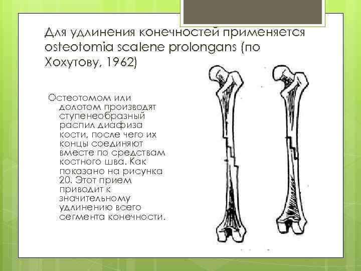 Для удлинения конечностей применяется osteotomia scalene prolongans (по Хохутову, 1962) Остеотомом или долотом производят