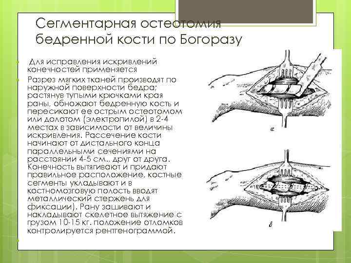 Сегментарная остеотомия бедренной кости по Богоразу Для исправления искривлений конечностей применяется Разрез мягких тканей