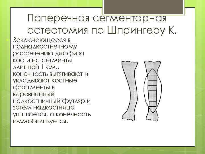 Поперечная сегментарная остеотомия по Шпрингеру К. Заключающееся в поднадкостнечному рассечению диафиза кости на сегменты