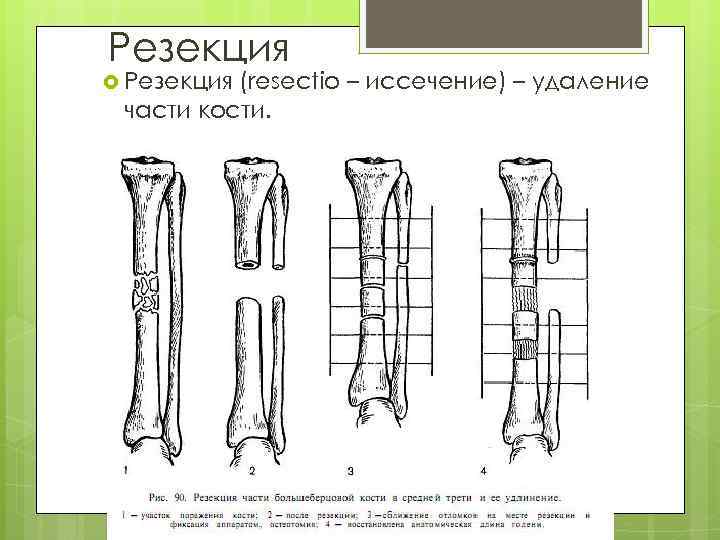 Резекция (resectio – иссечение) – удаление части кости. 