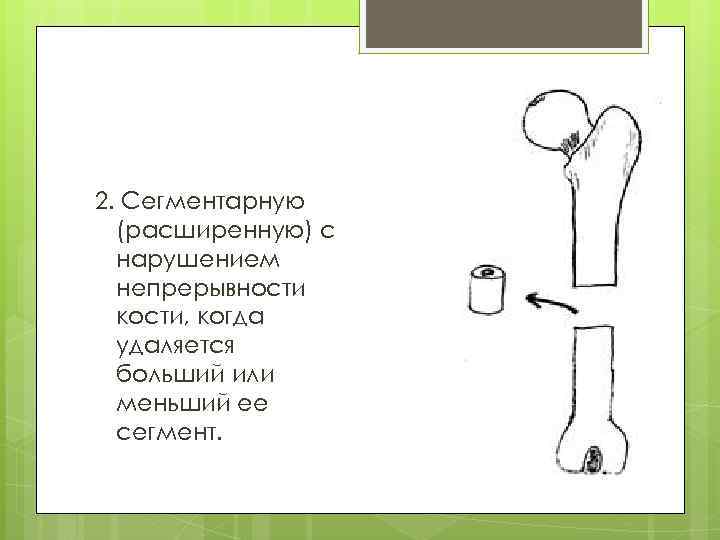 2. Сегментарную (расширенную) с нарушением непрерывности кости, когда удаляется больший или меньший ее сегмент.