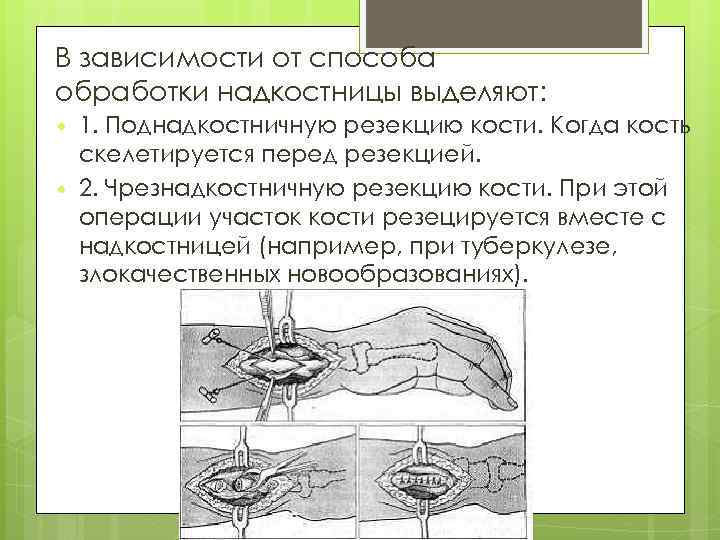 В зависимости от способа обработки надкостницы выделяют: 1. Поднадкостничную резекцию кости. Когда кость скелетируется