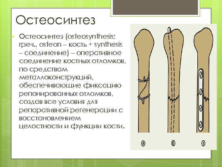 Остеосинтез (osteosynthesis; греч. , osteon – кость + synthesis – соединение) – оперативное соединение