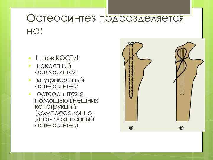 Остеосинтез подразделяется на: 1 шов КОСТИ; накостный остеосинтез; внутрикостный остеосинтез; остеосинтез с помощью внешних