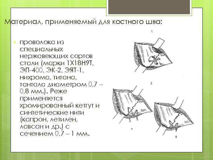 Материал, применяемый для костного шва: проволока из специальных нержавеющих сортов стали (марки 1 Х