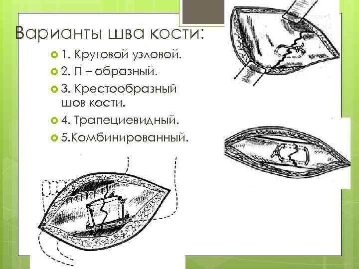 Варианты шва кости: 1. Круговой узловой. 2. П – образный. 3. Крестообразный шов кости.