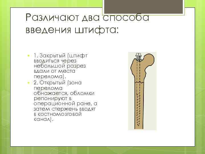 Различают два способа введения штифта: 1. Закрытый (штифт вводиться через небольшой разрез вдали от