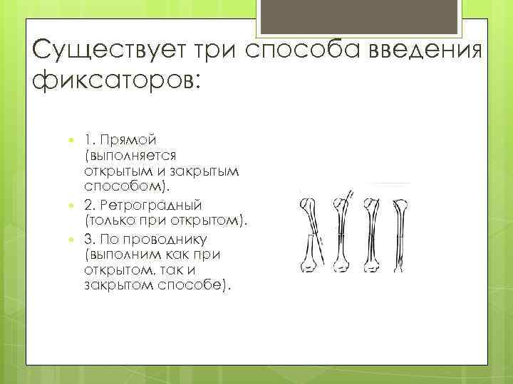 Существует три способа введения фиксаторов: 1. Прямой (выполняется открытым и закрытым способом). 2. Ретроградный