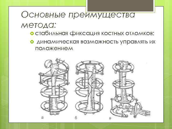 Основные преимущества метода: стабильная фиксация костных отломков; динамическая возможность управлять их положением 