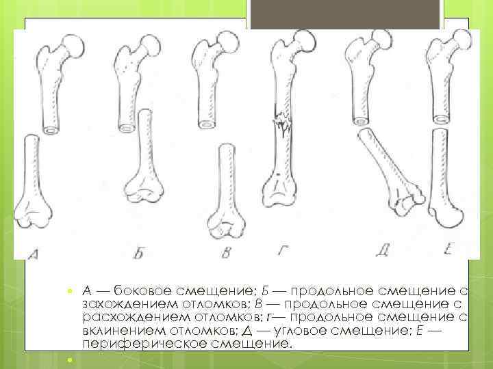  А — боковое смещение; Б — продольное смещение с захождением отломков; В —