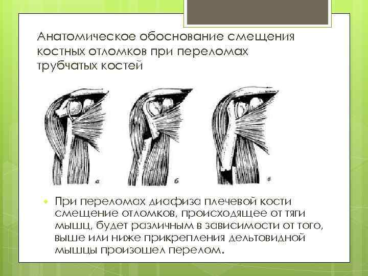 Анатомическое обоснование смещения костных отломков при переломах трубчатых костей При переломах диафиза плечевой кости