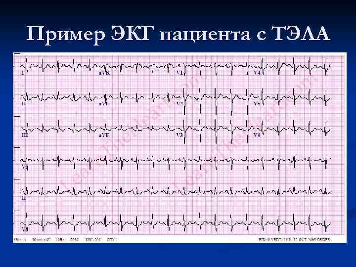 Пример ЭКГ пациента с ТЭЛА 