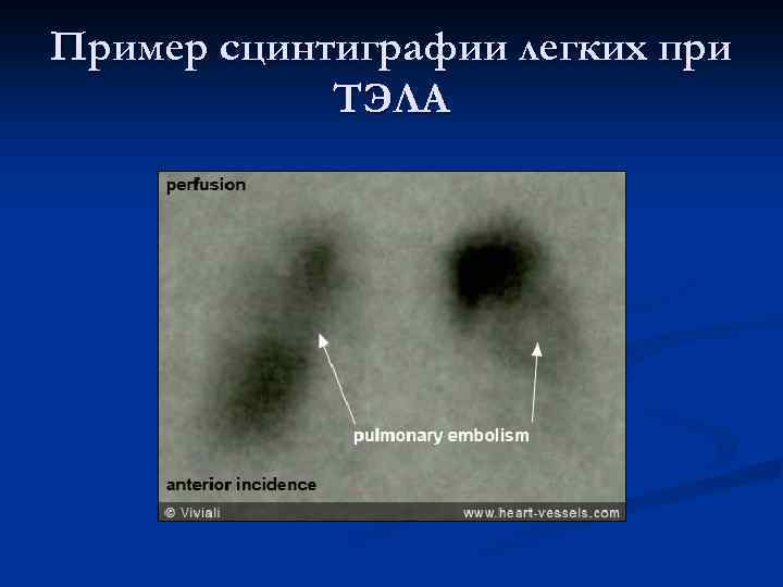 Пример сцинтиграфии легких при ТЭЛА 