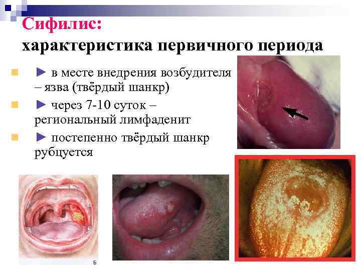 Сифилис: характеристика первичного периода ► в месте внедрения возбудителя – язва (твёрдый шанкр) ►