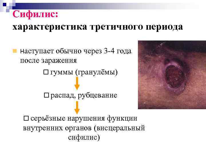 Сифилис: характеристика третичного периода наступает обычно через 3 -4 года после заражения гуммы (гранулёмы)