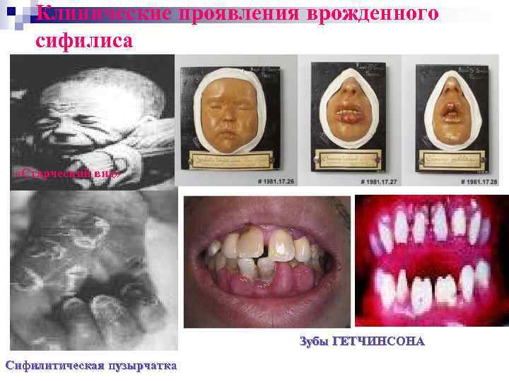 Клинические проявления врожденного сифилиса «Старческий вид» Зубы ГЕТЧИНСОНА Сифилитическая пузырчатка 