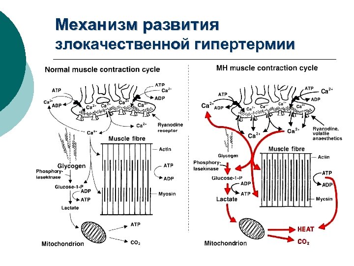 Механизм развития злокачественной гипертермии 