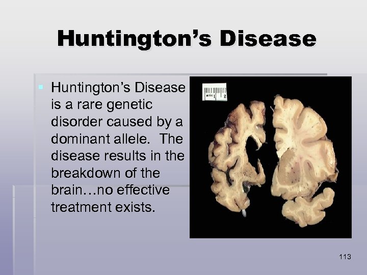 Huntington’s Disease § Huntington’s Disease is a rare genetic disorder caused by a dominant