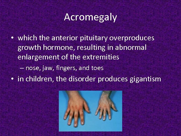 Acromegaly • which the anterior pituitary overproduces growth hormone, resulting in abnormal enlargement of